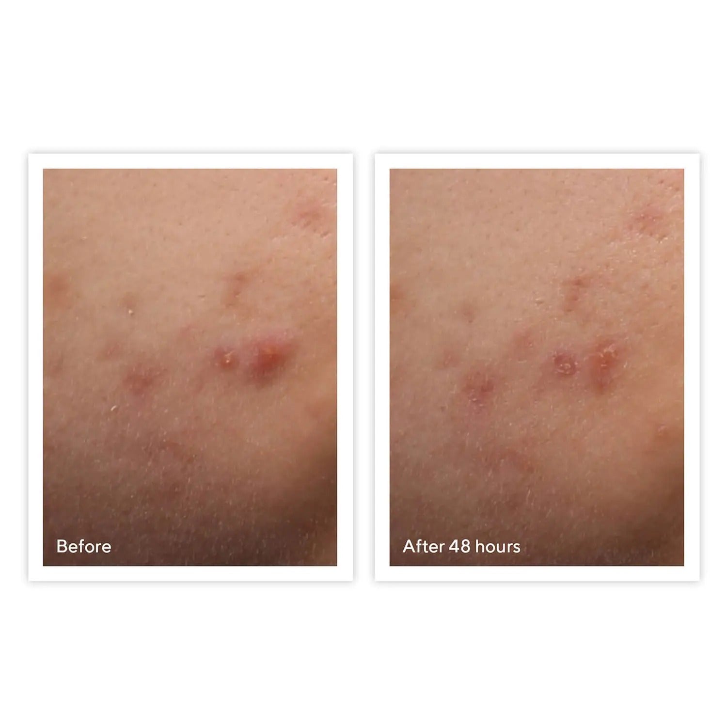 Murad Rapid Relief Acne Spot Treatment