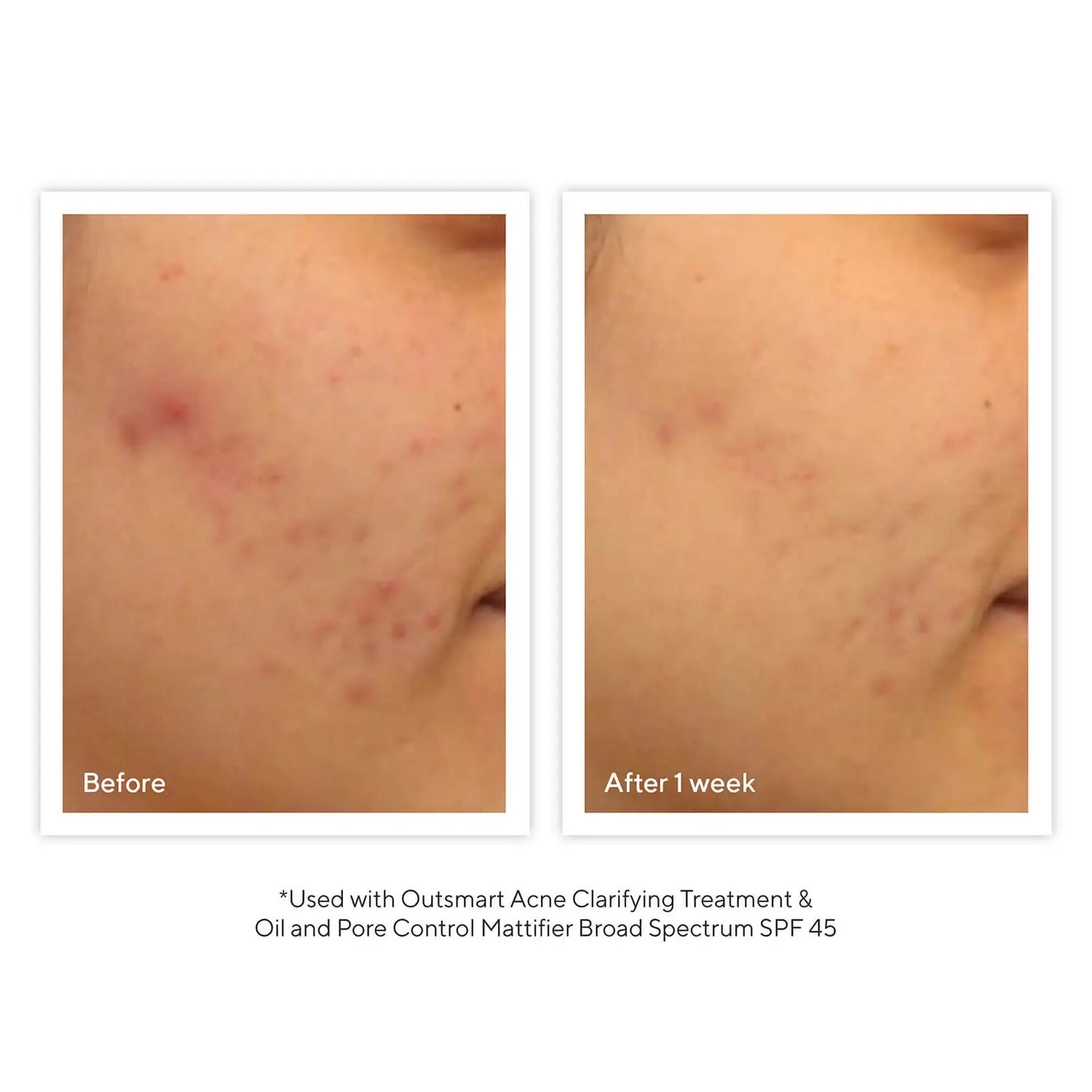 Murad Outsmart Acne Clarifying Treatment